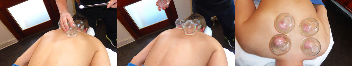 cupping